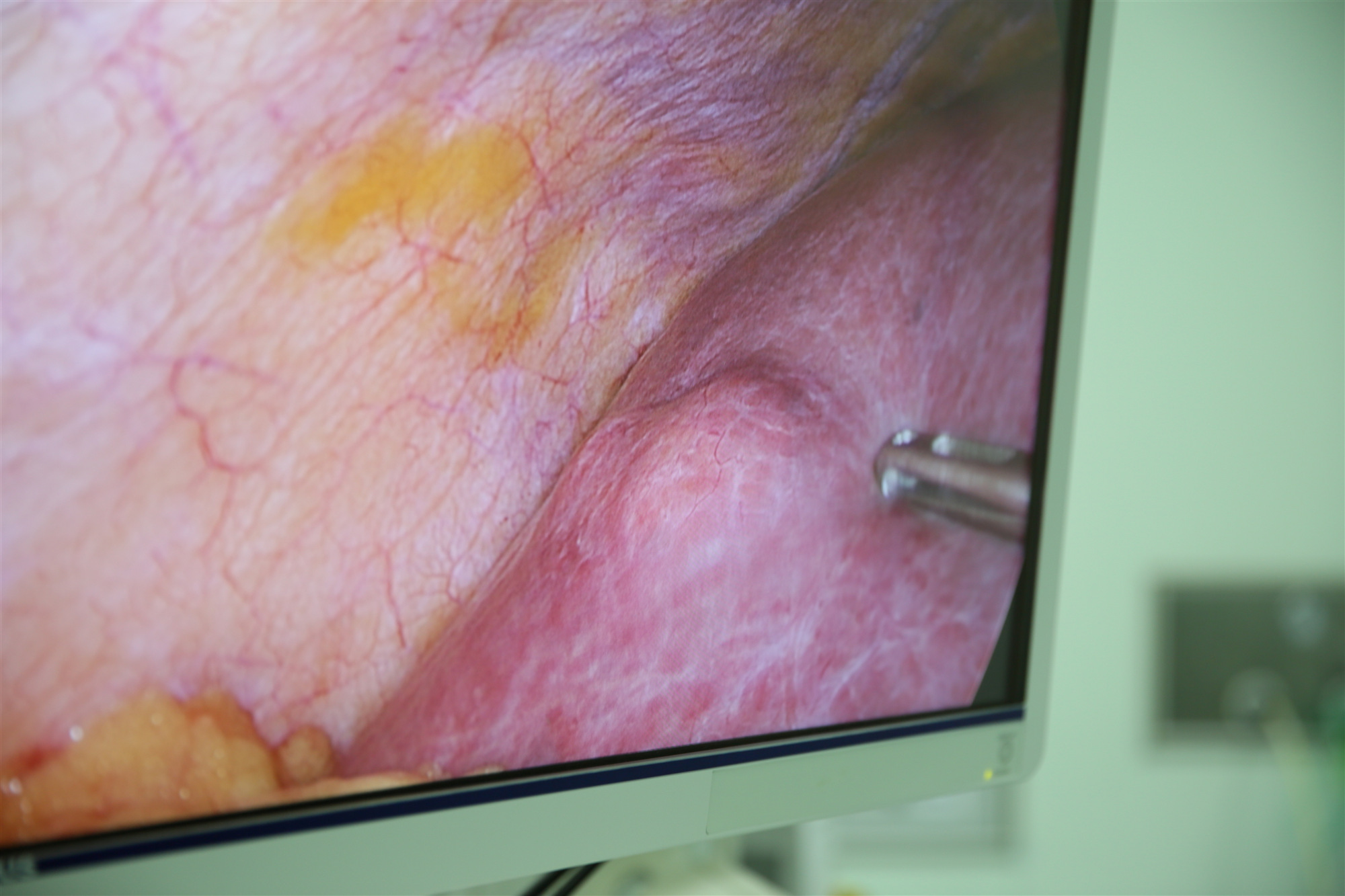 北流市人民医院肝胆、胃肠外科梁善强主任医师专家团队成功开展玉林巿首例肝脏肿瘤腔镜下射频消融术