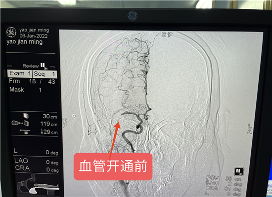 北流市人民医院独立开展颅内取栓术成功挽救急性脑梗塞患者